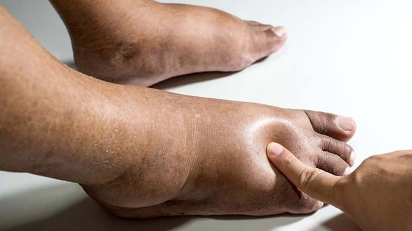 A foot showing diabetic symptoms.