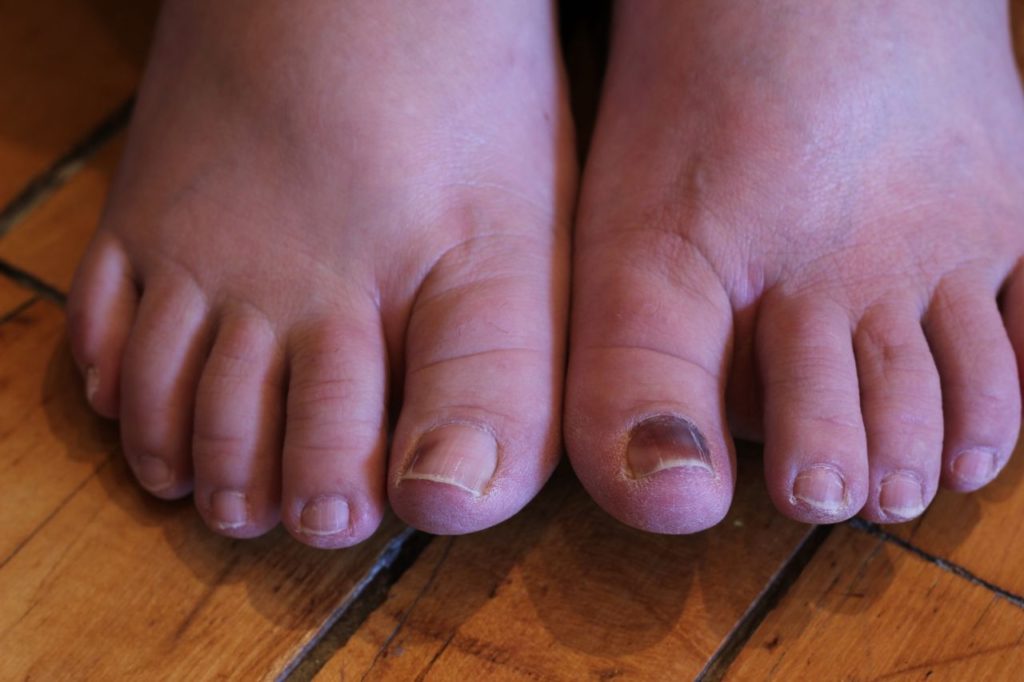 Choosing Shoes to Prevent Black Toenails Doctor Mitch Wachtel North